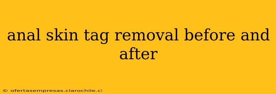 anal skin tag removal before and after