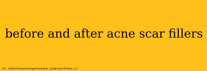 before and after acne scar fillers
