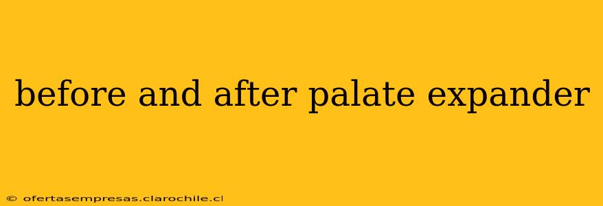 before and after palate expander