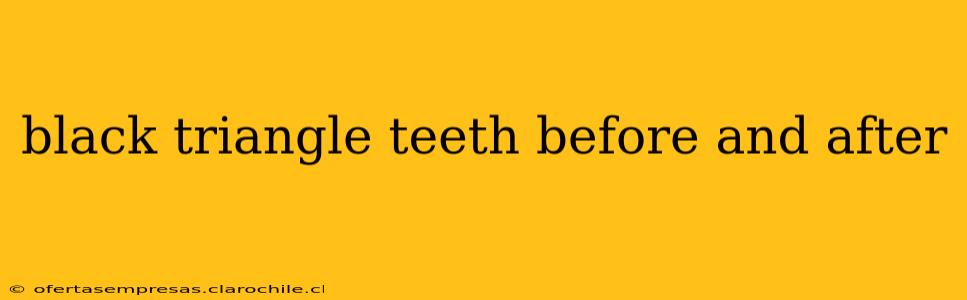 black triangle teeth before and after