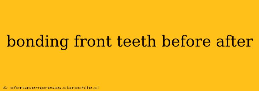 bonding front teeth before after