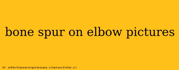 bone spur on elbow pictures