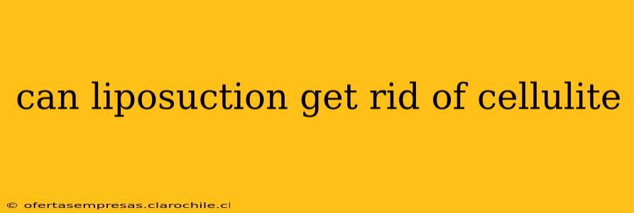 can liposuction get rid of cellulite