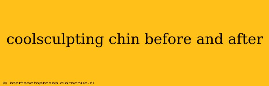 coolsculpting chin before and after