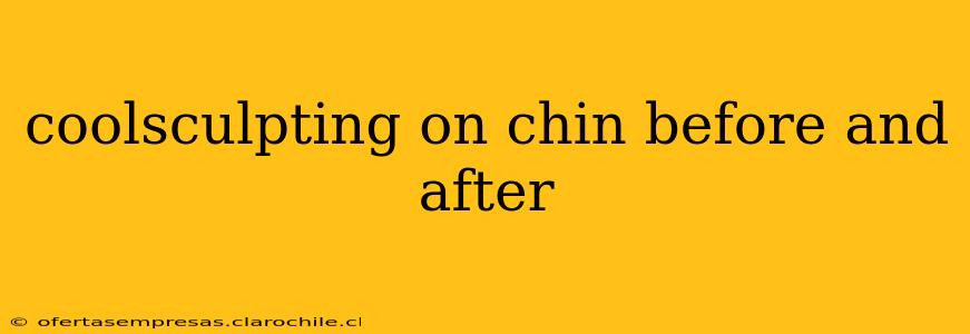 coolsculpting on chin before and after