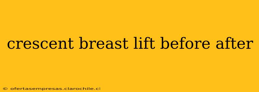 crescent breast lift before after