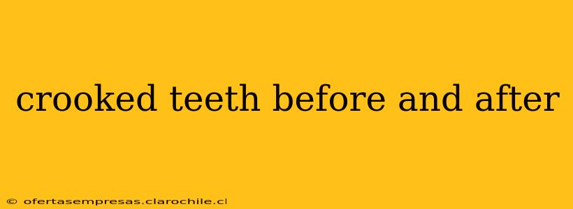 crooked teeth before and after