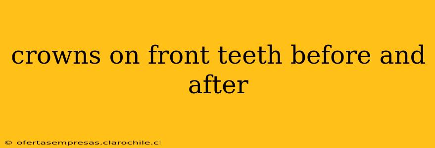 crowns on front teeth before and after