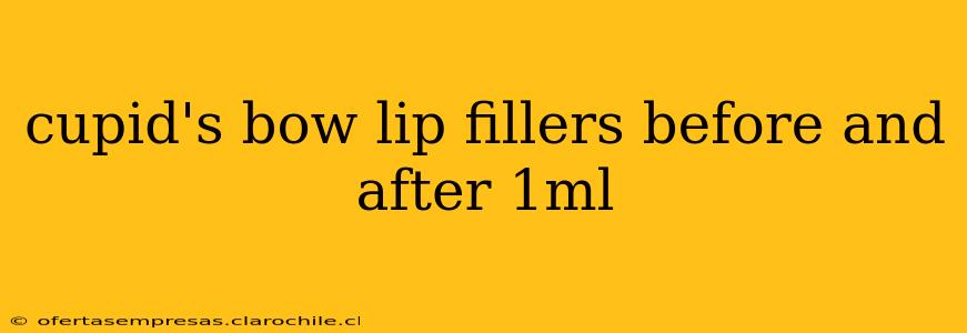 cupid's bow lip fillers before and after 1ml