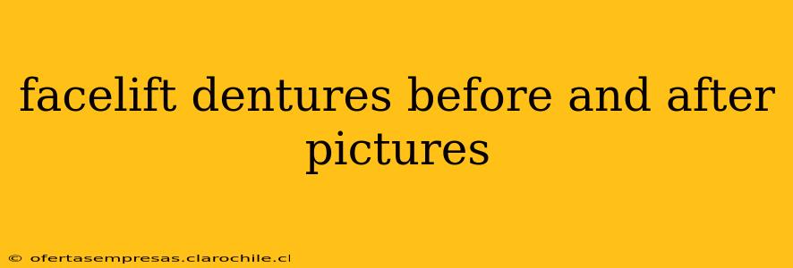 facelift dentures before and after pictures