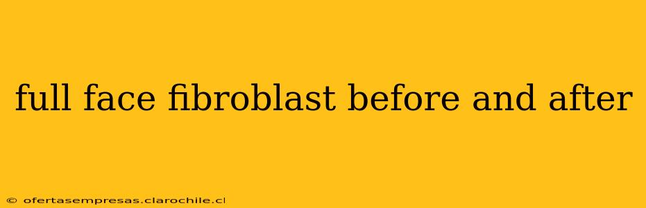 full face fibroblast before and after