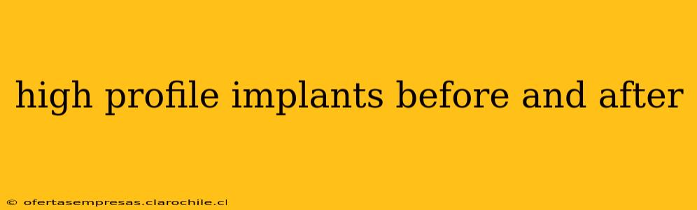 high profile implants before and after