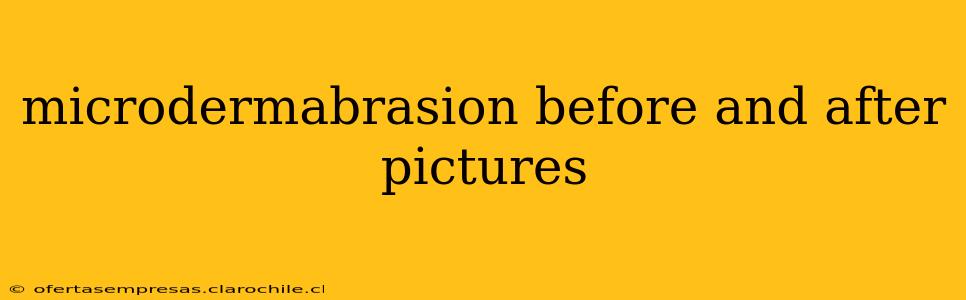 microdermabrasion before and after pictures