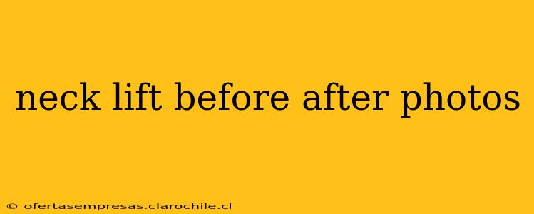 neck lift before after photos