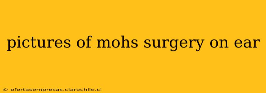 pictures of mohs surgery on ear