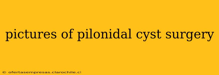 pictures of pilonidal cyst surgery