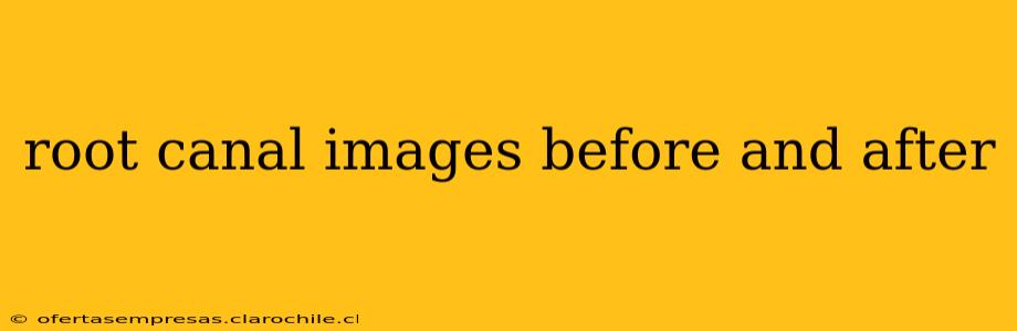root canal images before and after