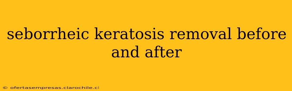 seborrheic keratosis removal before and after