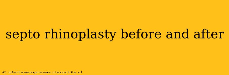septo rhinoplasty before and after