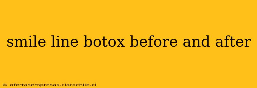 smile line botox before and after