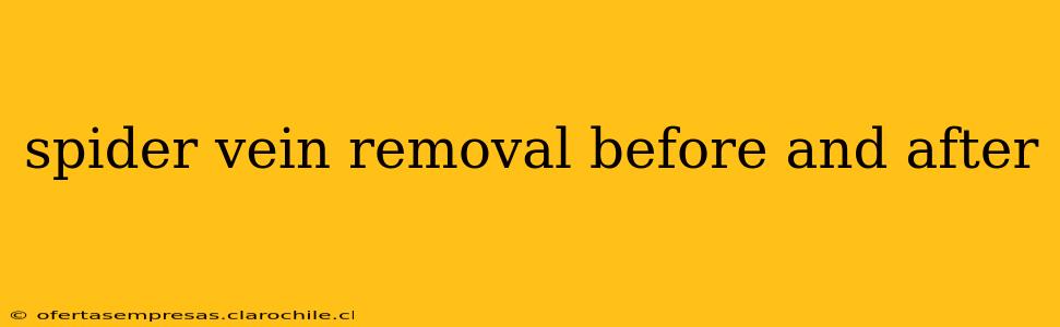 spider vein removal before and after