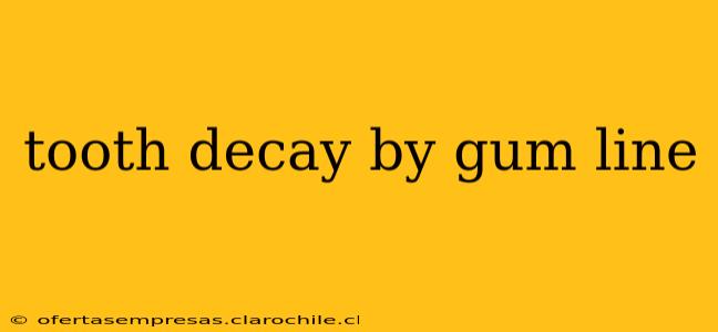 tooth decay by gum line