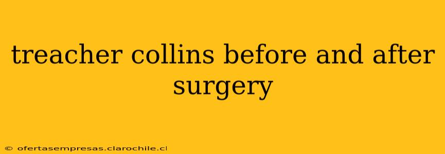 treacher collins before and after surgery