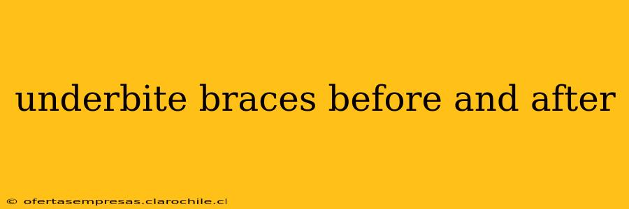 underbite braces before and after