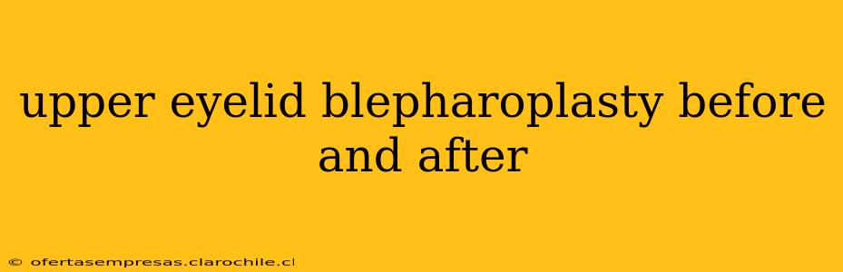 upper eyelid blepharoplasty before and after