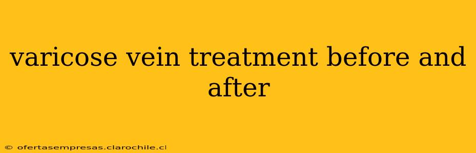 varicose vein treatment before and after