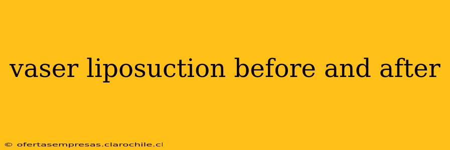 vaser liposuction before and after