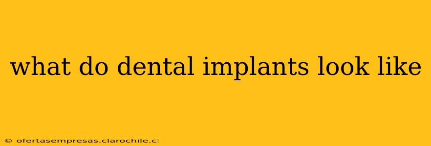 what do dental implants look like