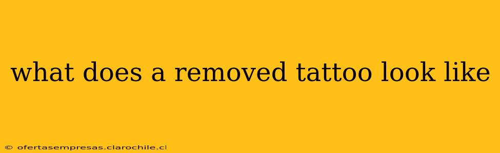 what does a removed tattoo look like